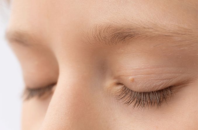 How do I remove a skin tag on my eyelid? How do I remove a skin tag on my eyelid?