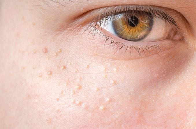 closeup under eye with syringoma closeup under eye with syringoma