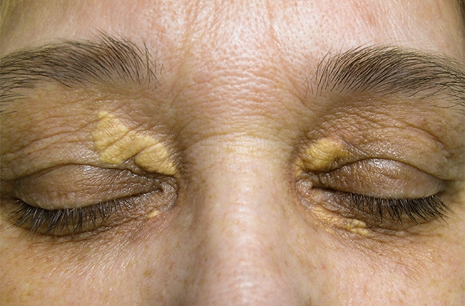 closeup of eyes with xanthelasma closeup of eyes with xanthelasma
